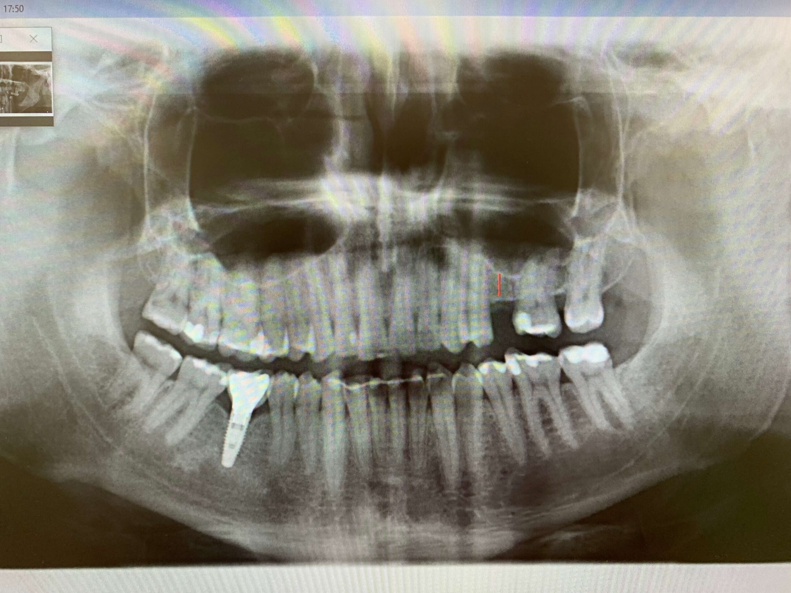 implantes-dentales-1