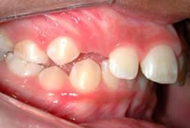 protrusion dental