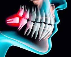 CIRUGIA ORAL H2