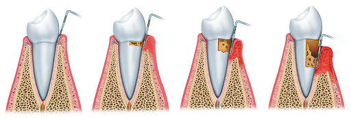 1 PERIODONCIA H2