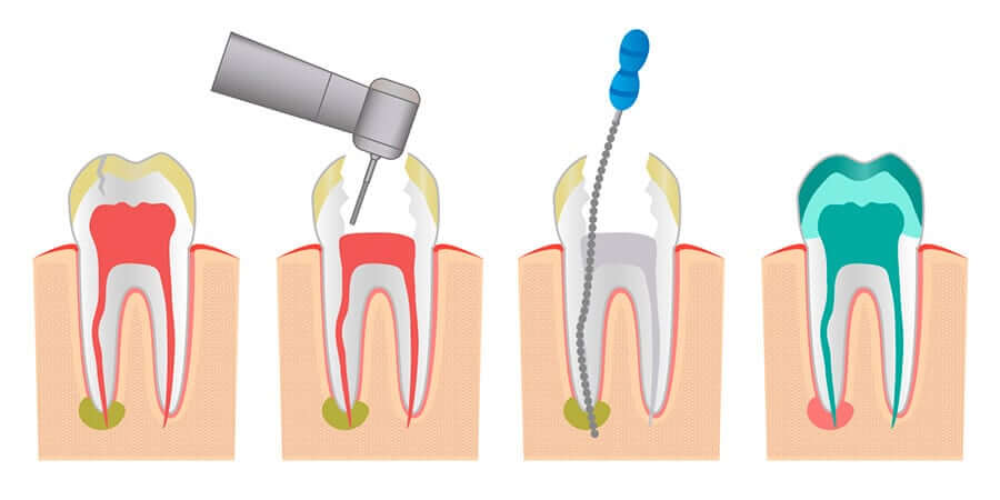 ENDODONCIA H2