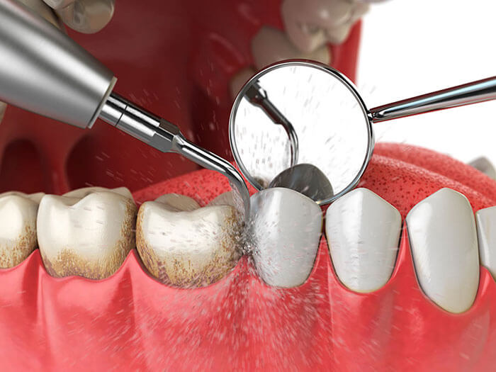 TRATMIENTO PERIODONCIA H2