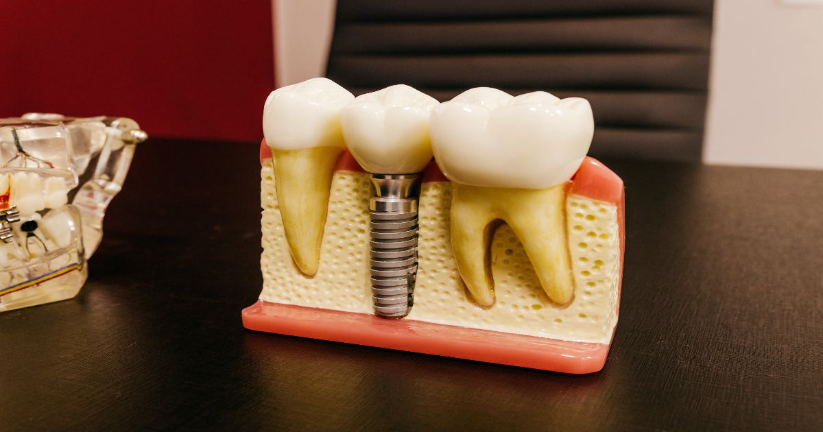 precio implantes dentales