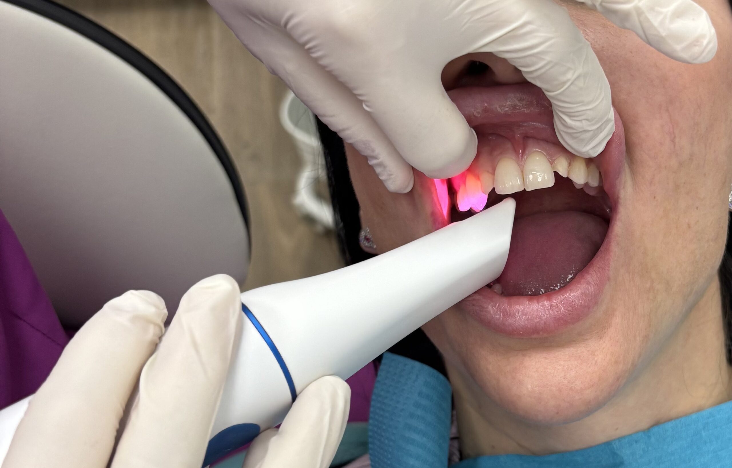 diseño mediante escaner de tratamiento dental